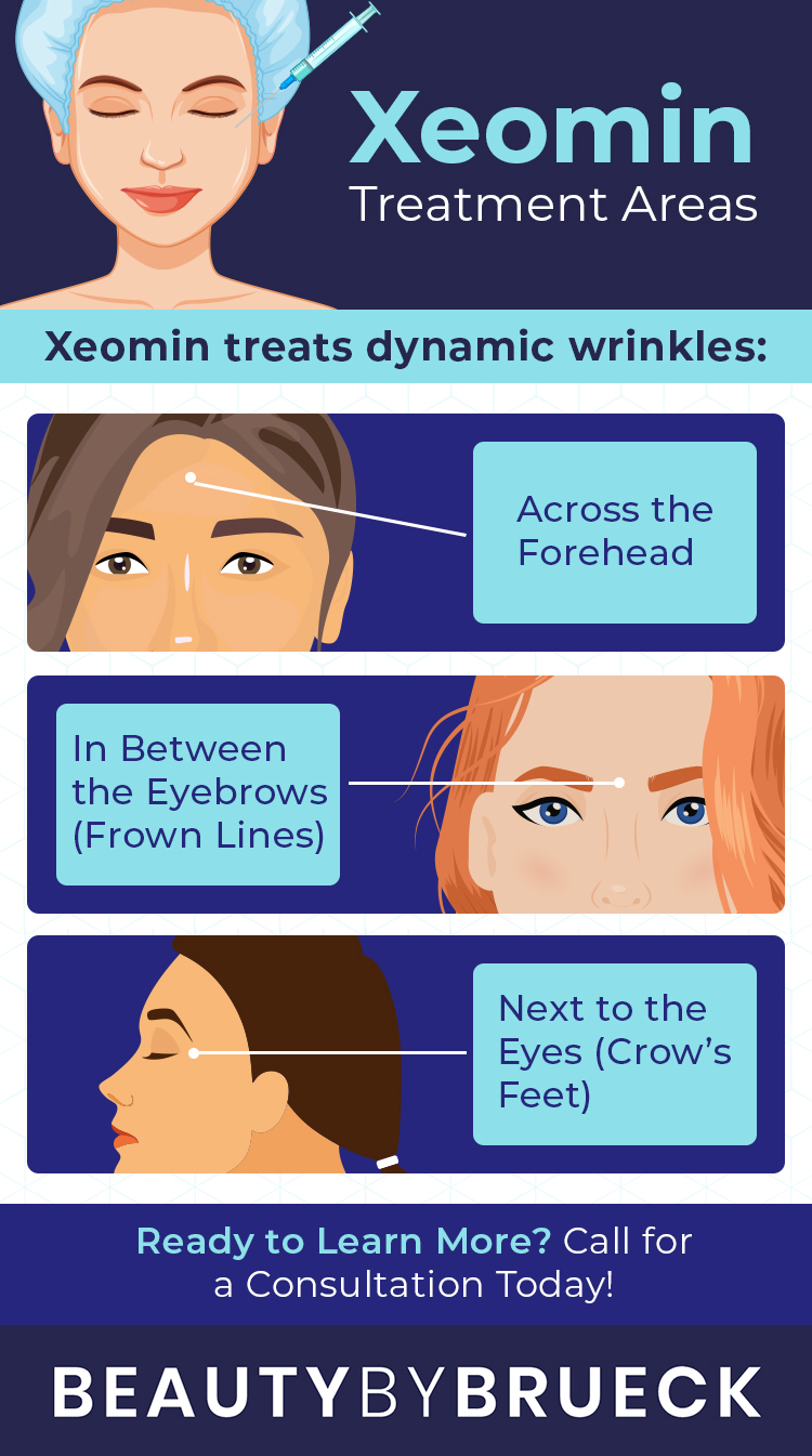 Infographic: Xeomin Treatment Areas