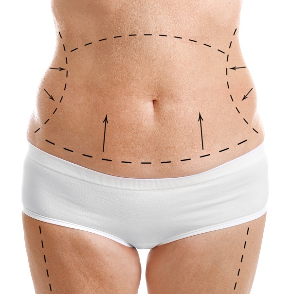 Torso with markings for body lift surgery