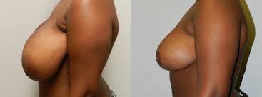 breast reduction before and after photo - Northern Virginia