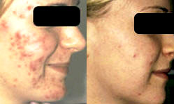 before and after acne treatment with Palomar LuxV