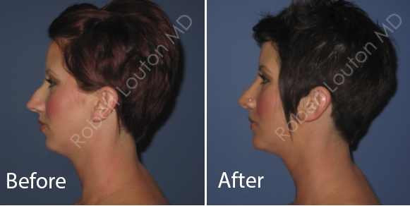 before and after rhinoplasty | actual patient of Blair Plastic Surgery