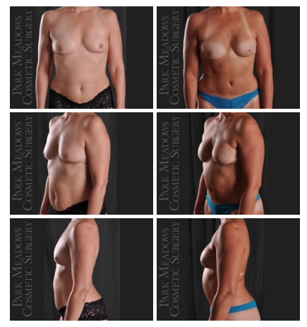 DIEP Flap breast reconstruction using autologous fat - before and after