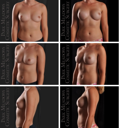 direct-to-implant breast reconstruction - before and after