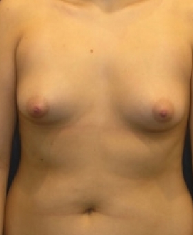 Woman with a B cup prior to breast enhancement surgery