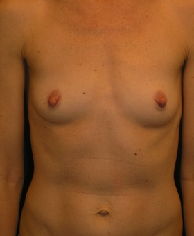 Before Breast Implant Surgery