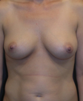 Before Breast Augmentation Surgery