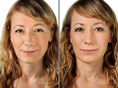 before-after-restylane.jpg