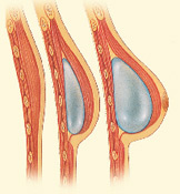 diagram of breast expander with saline implant for reconstruction
