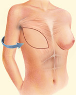 completed brest reconstruction after Latissimus Dorsi procedure