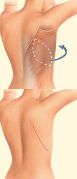 diagram of Latissimus Dorsi flap procedure for breast reconstruction - before and after