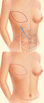 diagram of TRAM flap breast reconstruction - before and after