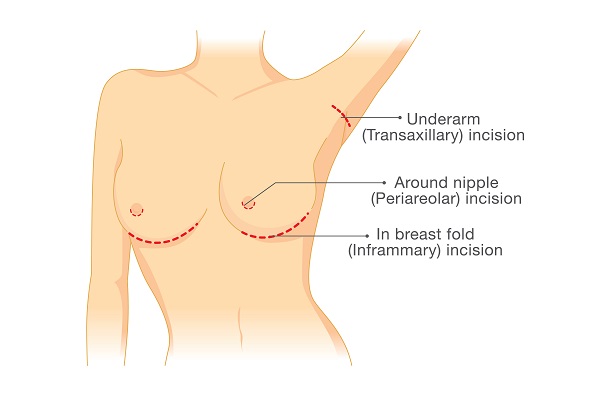 Infographic: Breast Augmentation Incision Options