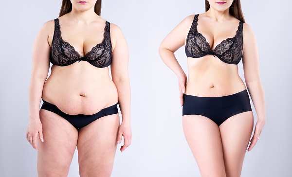 Tummy Tuck Before and After