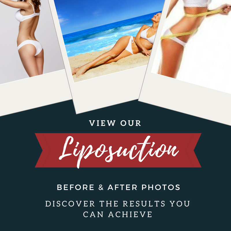 Liposuction Before and After Photos Oklahoma City