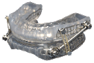 The SUAD™ Device for sleep apnea