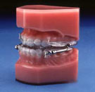 Herbst Telescopic Appliance