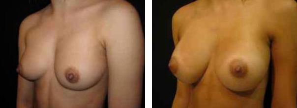 before and after breast augmentation photos