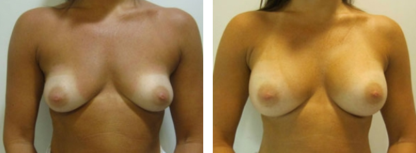 before-and-after photo of breast augmentation - side view