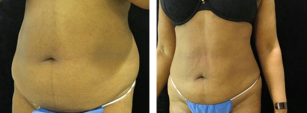 liposuction of the stomatch - before and after