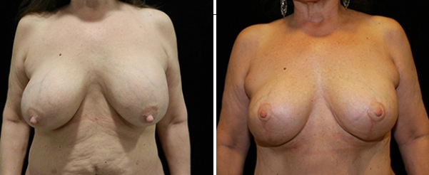 breast reduction before and after | Joshua B. Hyman, M.D.