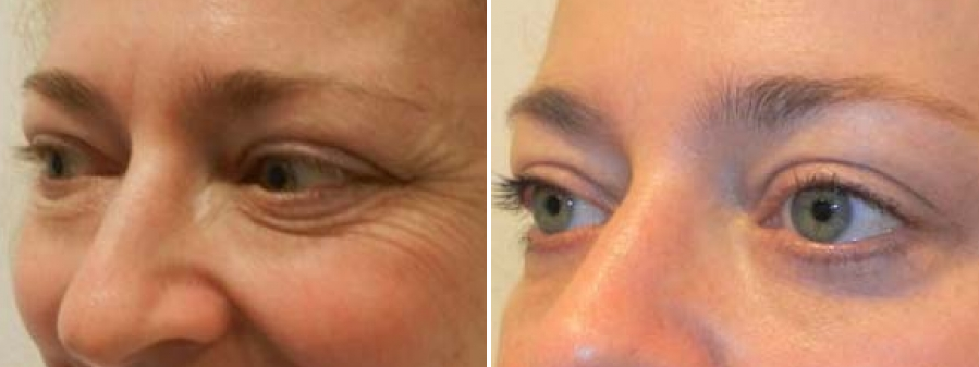 Eyelid patient image