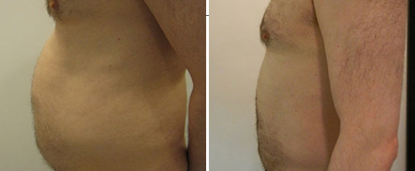 male liposuction of the stomach - before and after
