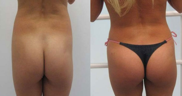 Dr. Omidi's Butt Augmentation Before & After Gallery - Beverly Hills Plastic Surgeon