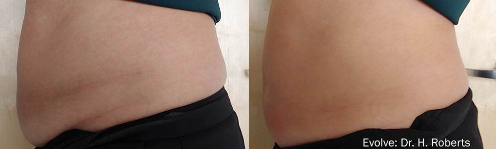 Evolve Tite treatment for the abdomen