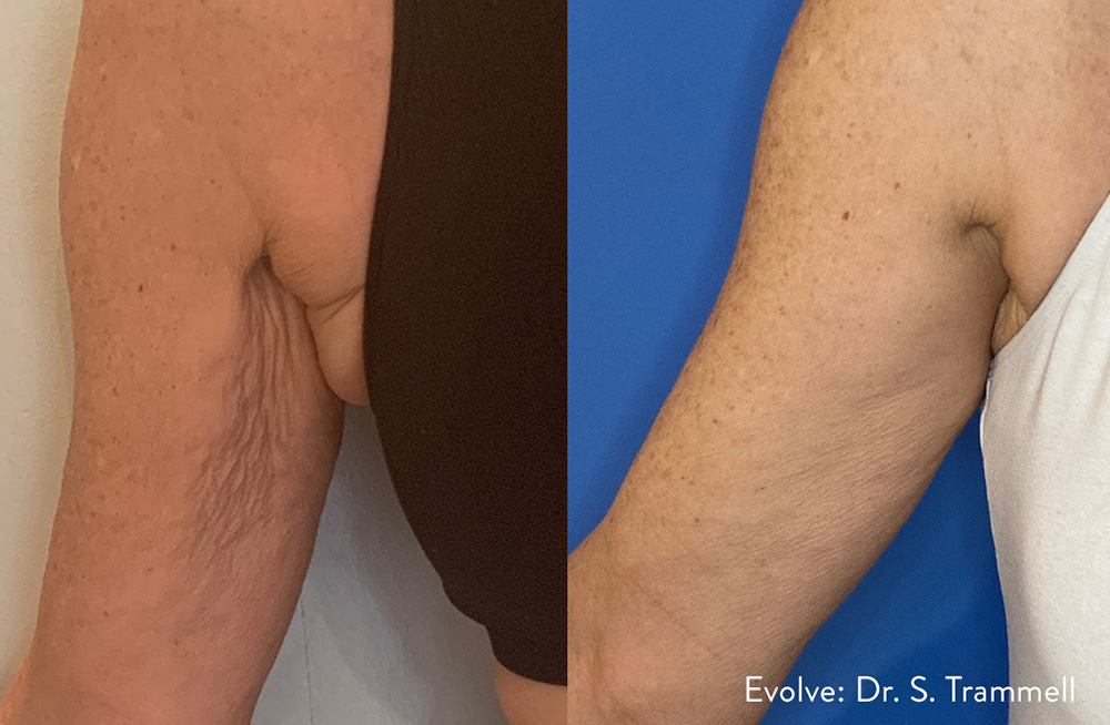 Evolve Tite treatment for the abdomen