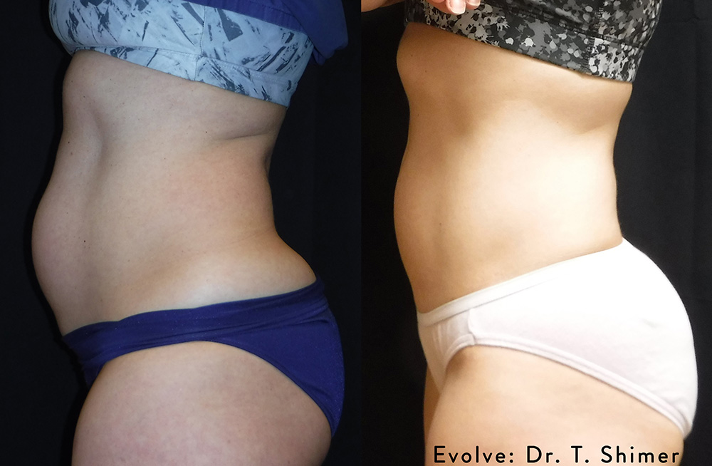 Evolve Tite treatment for the abdomen