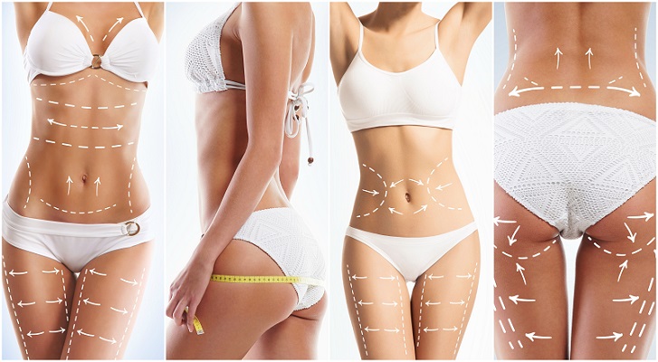 Liposuction Treatment Areas
