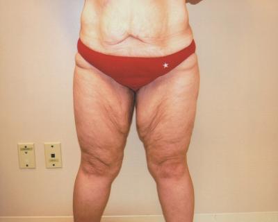 Thigh Lift Before After Gallery Dr Richard Lee Newport Beach Ca