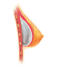 breast implant position below the muscle