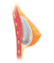 breast implant position above the muscle