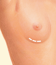 under the breast incision for breast augmentation