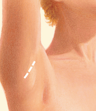 under the armpit incision for breast augmentation