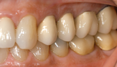 Dental crowns fabricated in 1985