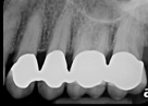 Dental X-ray for dental crown taken in 2019