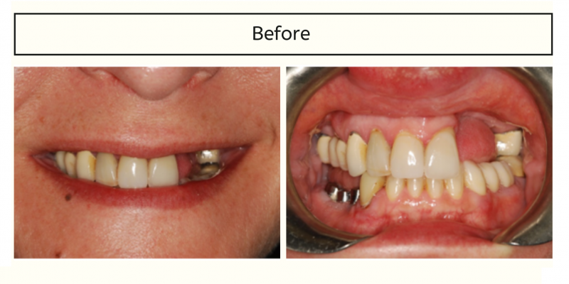 Before photo smile makeover patient in D.C.