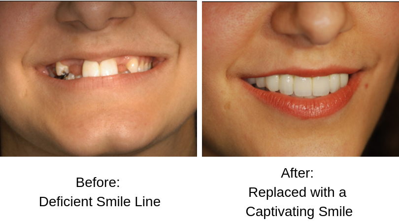 Deficient Smile to Captivating Smile.png