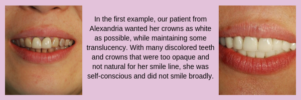Dental Crown Before and After | Prosthetic Dentistry of Washington DC