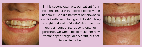 Dental Crown Before and After | Prosthetic Dentistry of Washington DC