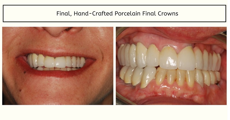 Patient after smile makeover in D.C.