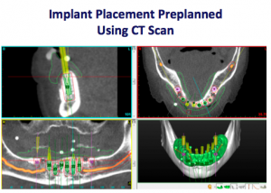 Implant Placement Preplanning with CT Scan