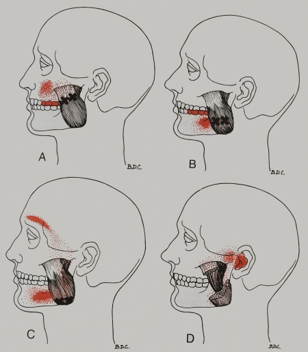 Masseter-Muscle-2.jpg