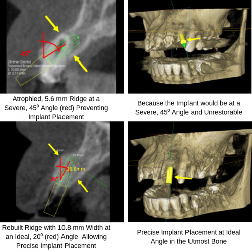 Severe Angle Implant Placement.png