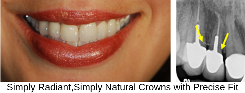 Simply%20Radiant%2C%20Simply%20Natural%20Crowns%20with%20Precise%20Fit.png