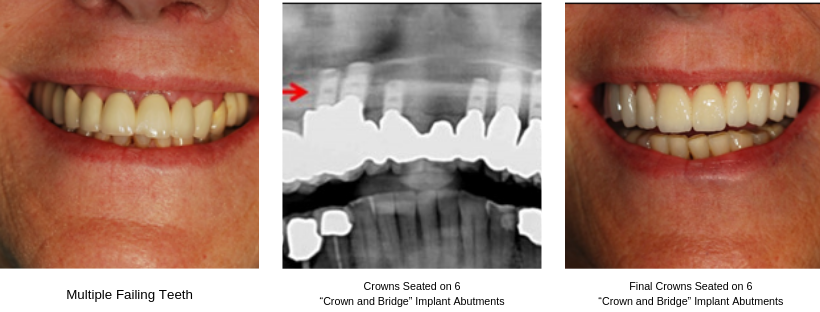 Six Implant Restoration 2