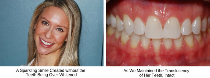 Before and After Teeth Whitening
