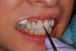 Internal Custom Staining to Match to the Adjacent Tooth